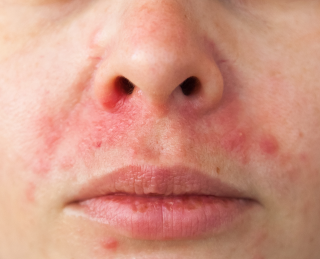 Individual with perioral dermatitis