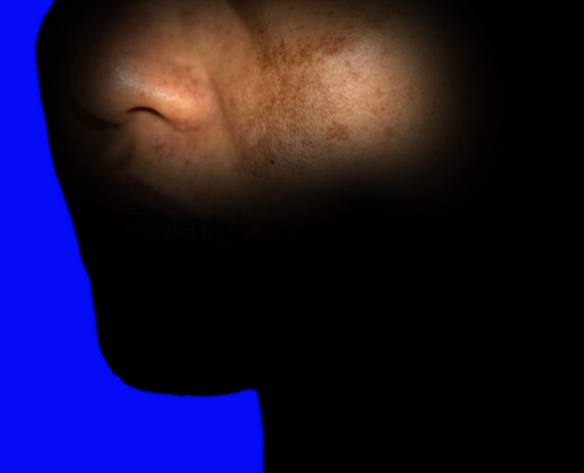 Melasma on cheek