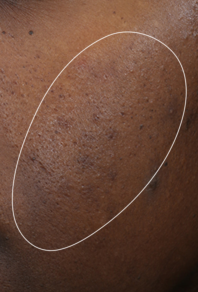 CONSIDERATIONS FOR ACNE-PRONE SKIN