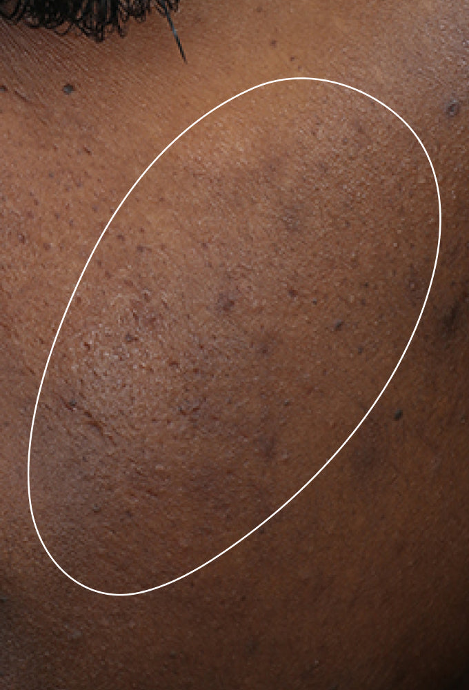 CONSIDERATIONS FOR ACNE-PRONE SKIN